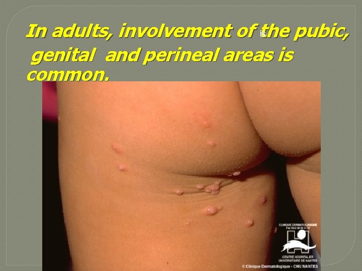 is In adults, involvement of the pubic, genital and perineal areas is common. 