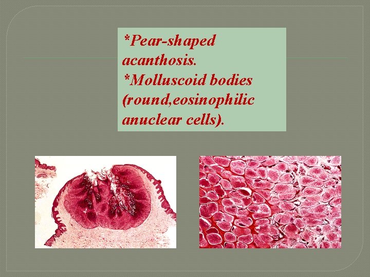 *Pear-shaped acanthosis. *Molluscoid bodies (round, eosinophilic anuclear cells). 