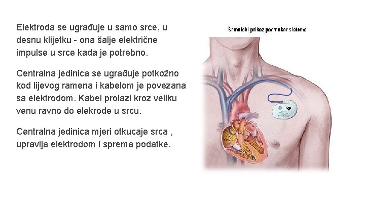 Elektroda se ugrađuje u samo srce, u desnu klijetku - ona šalje električne impulse