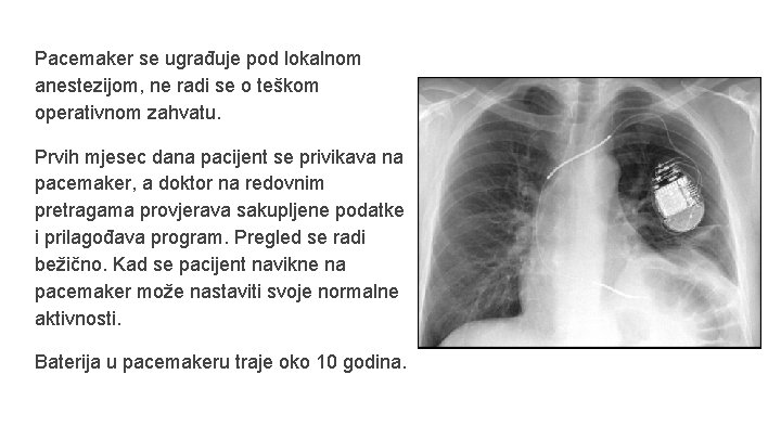 Pacemaker se ugrađuje pod lokalnom anestezijom, ne radi se o teškom operativnom zahvatu. Prvih