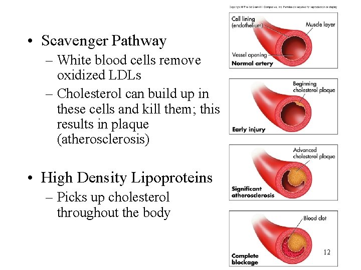  • Scavenger Pathway – White blood cells remove oxidized LDLs – Cholesterol can