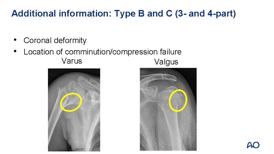 Additional information: Type B and C (3 - and 4 -part) • Coronal deformity