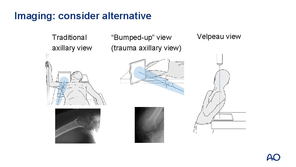 Imaging: consider alternative Traditional axillary view “Bumped-up” view (trauma axillary view) Velpeau view 