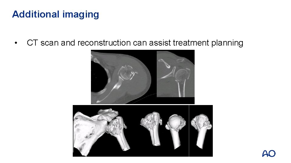 Additional imaging • CT scan and reconstruction can assist treatment planning 