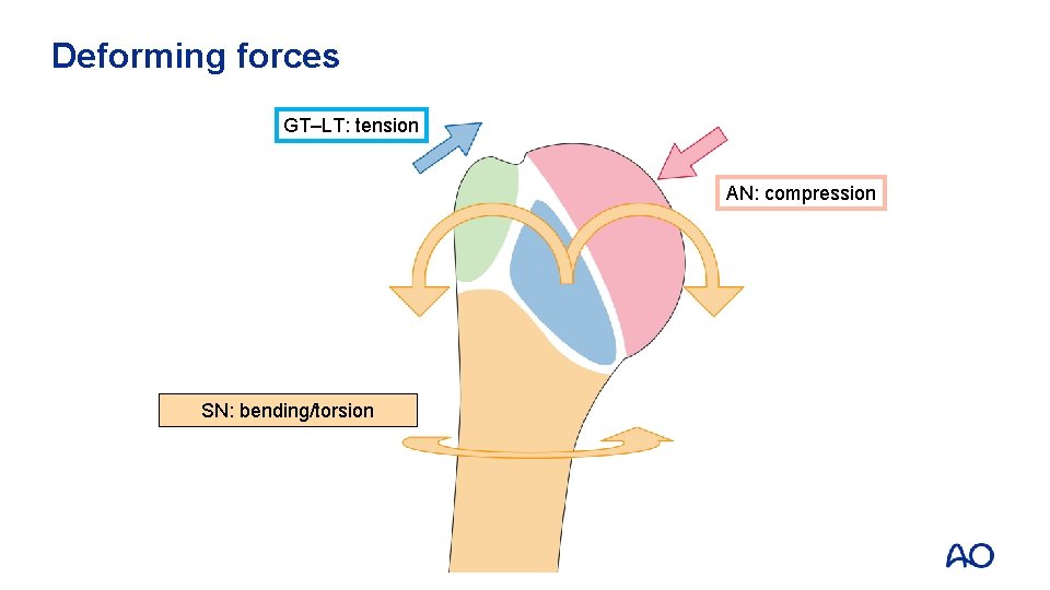 Deforming forces GT–LT: tension AN: compression SN: bending/torsion 