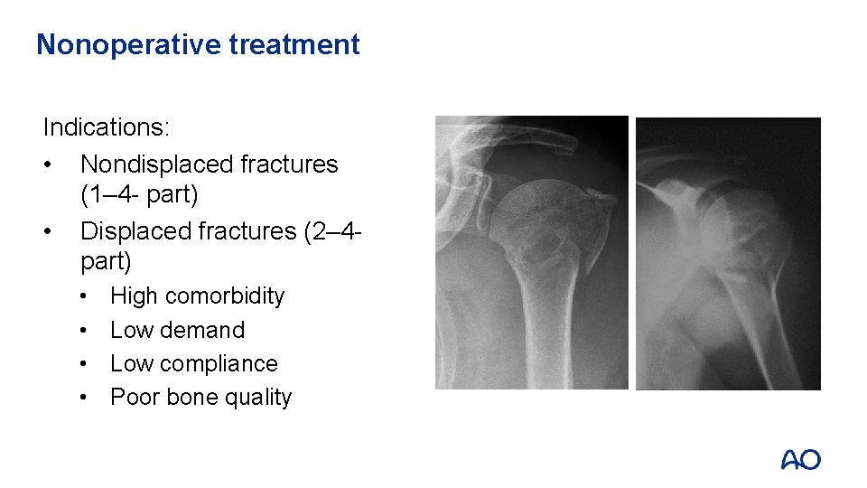 Nonoperative treatment Indications: • Nondisplaced fractures (1– 4 - part) • Displaced fractures (2–