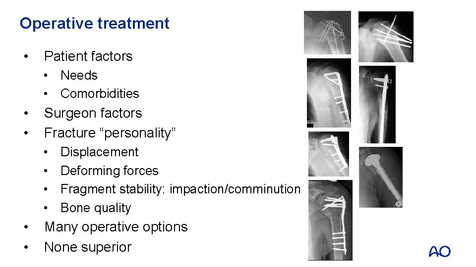 Operative treatment • Patient factors • Needs • Comorbidities • • Surgeon factors Fracture