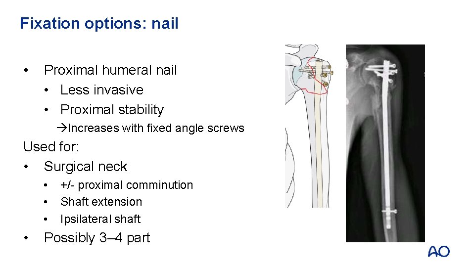 Fixation options: nail • Proximal humeral nail • Less invasive • Proximal stability Increases