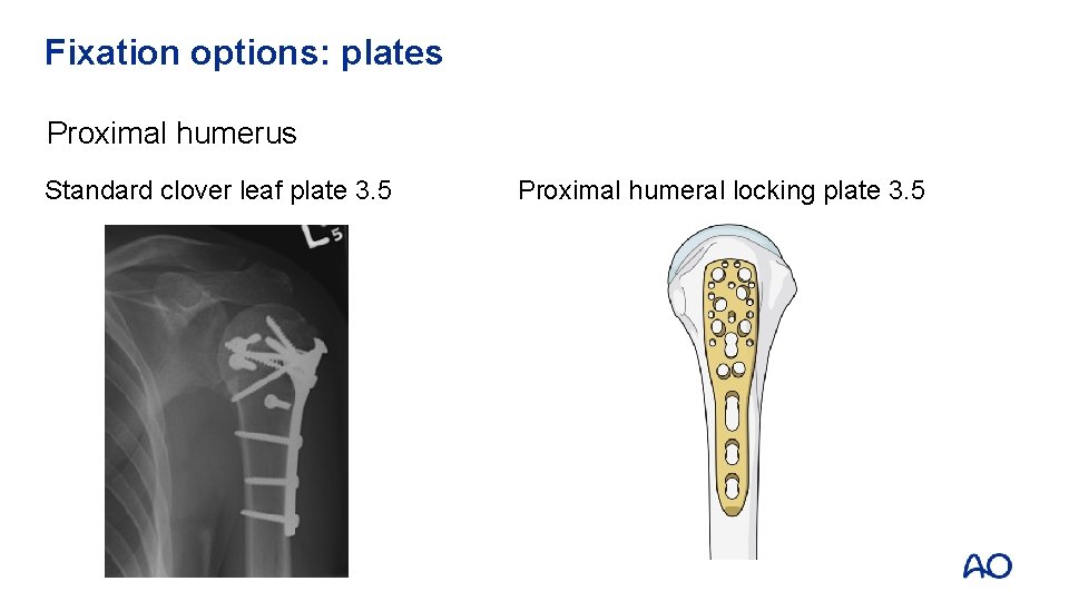 Fixation options: plates Proximal humerus Standard clover leaf plate 3. 5 Proximal humeral locking