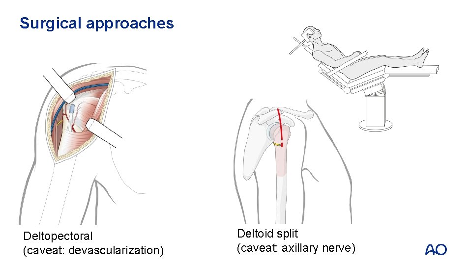 Surgical approaches Deltopectoral (caveat: devascularization) Deltoid split (caveat: axillary nerve) 