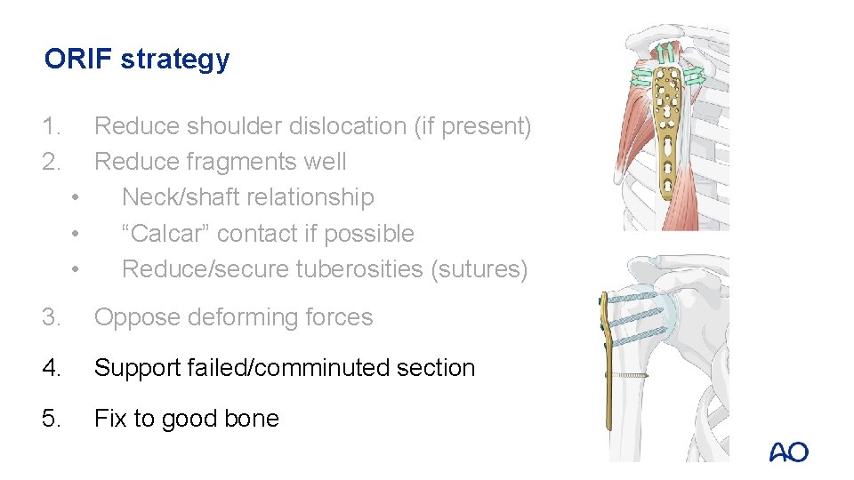 ORIF strategy 1. 2. Reduce shoulder dislocation (if present) Reduce fragments well • Neck/shaft