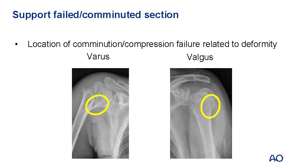 Support failed/comminuted section • Location of comminution/compression failure related to deformity Varus Valgus 