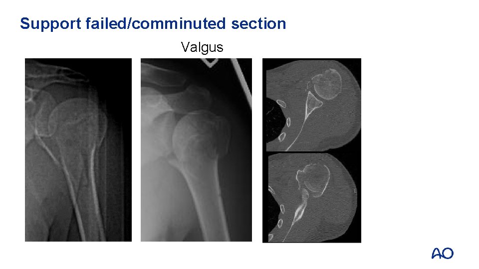 Support failed/comminuted section Valgus 