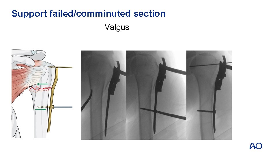 Support failed/comminuted section Valgus 