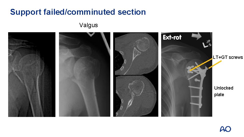 Support failed/comminuted section Valgus LT+GT screws Unlocked plate 