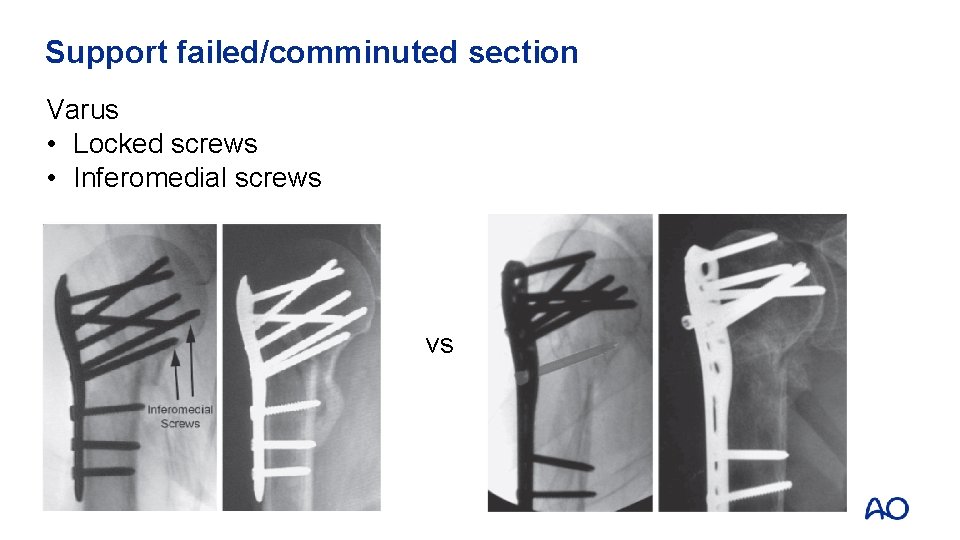 Support failed/comminuted section Varus • Locked screws • Inferomedial screws vs 