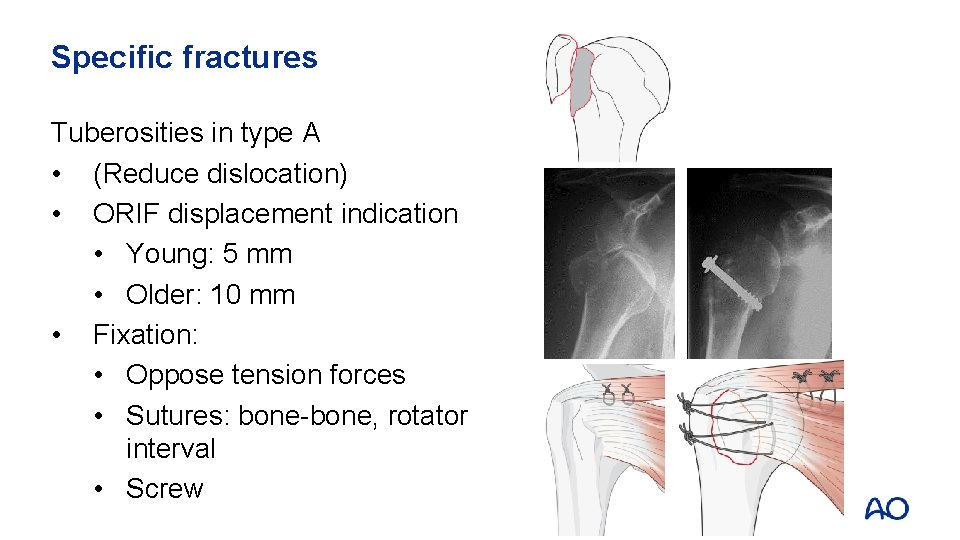 Specific fractures Tuberosities in type A • (Reduce dislocation) • ORIF displacement indication •