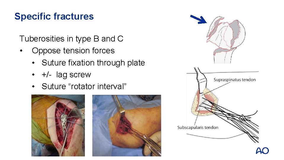 Specific fractures Tuberosities in type B and C • Oppose tension forces • Suture
