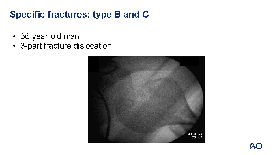 Specific fractures: type B and C • 36 -year-old man • 3 -part fracture