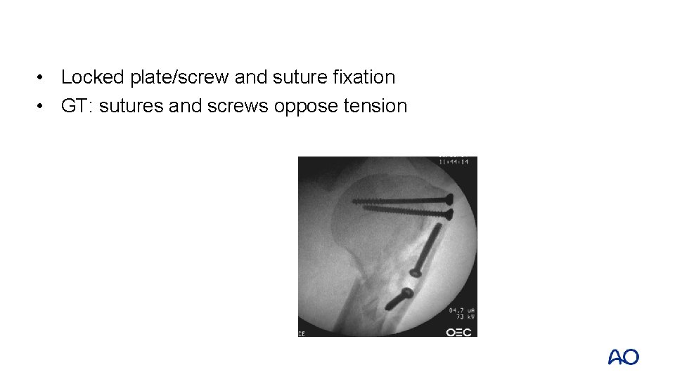  • Locked plate/screw and suture fixation • GT: sutures and screws oppose tension