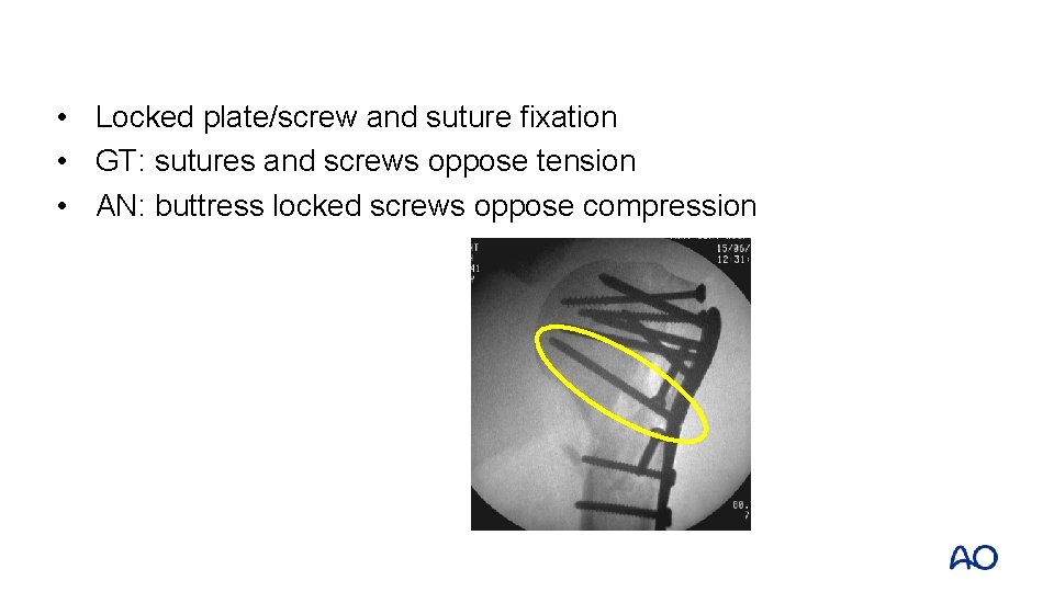  • Locked plate/screw and suture fixation • GT: sutures and screws oppose tension