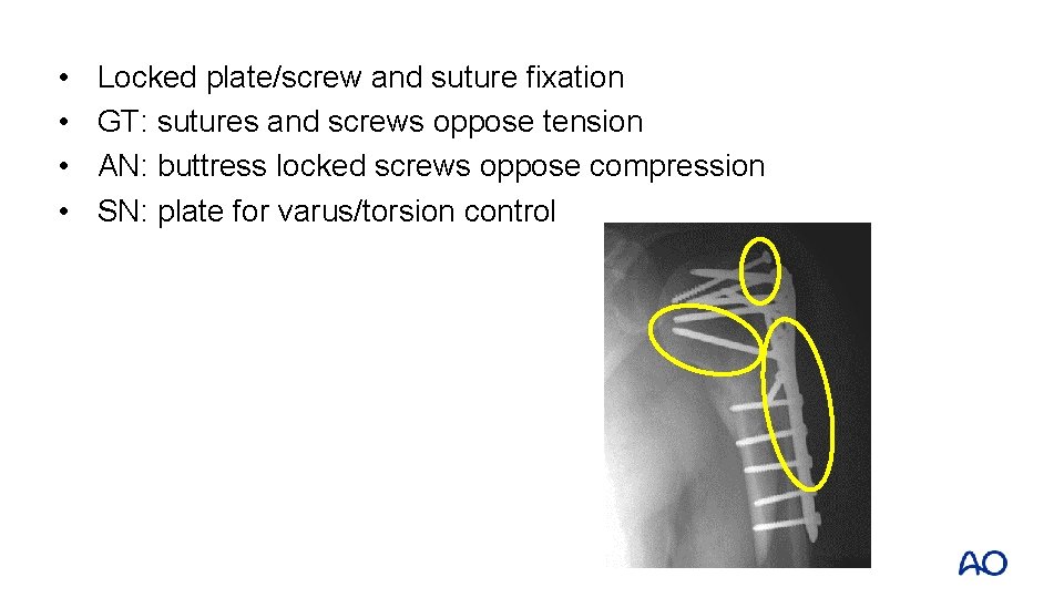  • • Locked plate/screw and suture fixation GT: sutures and screws oppose tension