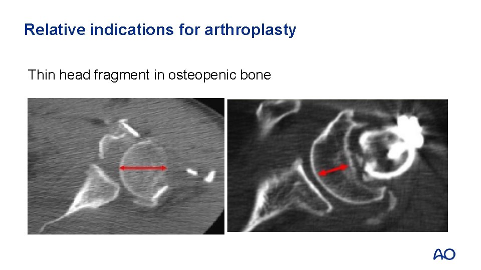 Relative indications for arthroplasty Thin head fragment in osteopenic bone 