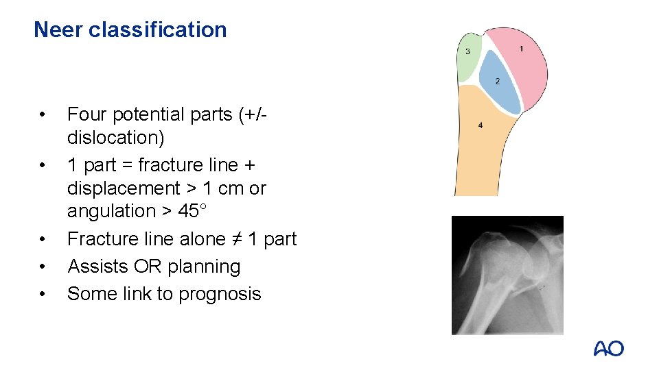 Neer classification • • • Four potential parts (+/dislocation) 1 part = fracture line