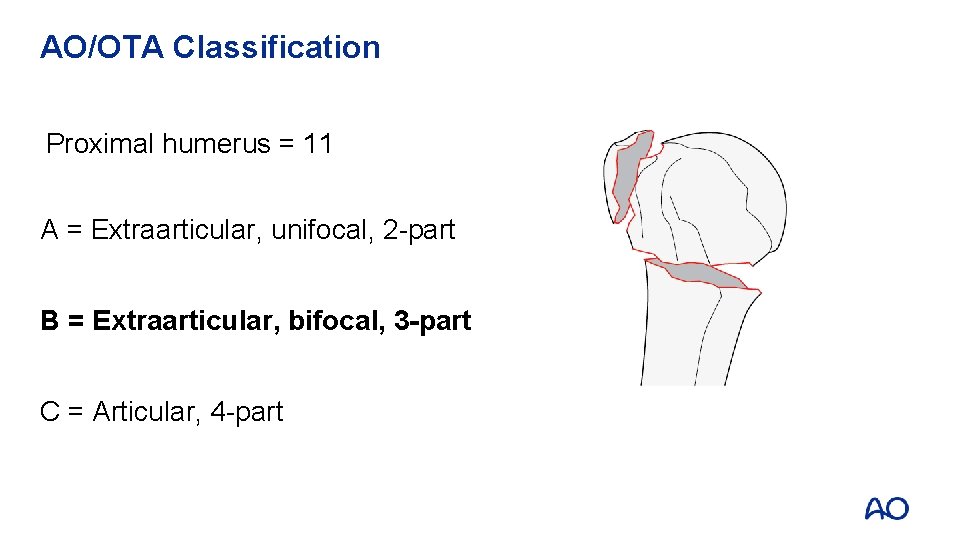 AO/OTA Classification Proximal humerus = 11 A = Extraarticular, unifocal, 2 -part B =