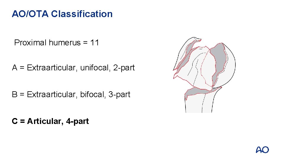 AO/OTA Classification Proximal humerus = 11 A = Extraarticular, unifocal, 2 -part B =