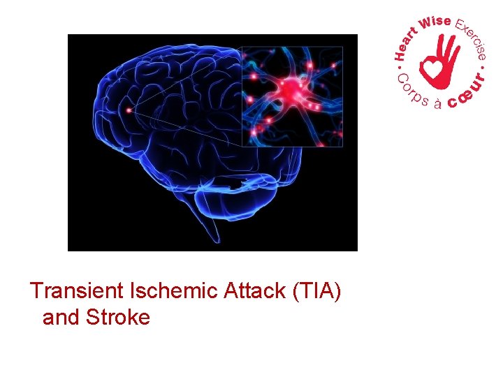 Transient Ischemic Attack (TIA) and Stroke 