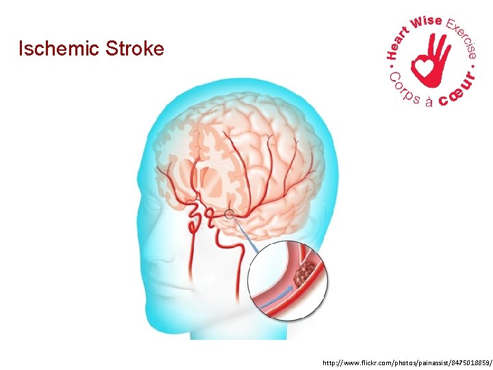 Ischemic Stroke http: //www. flickr. com/photos/painassist/8475018859/ 