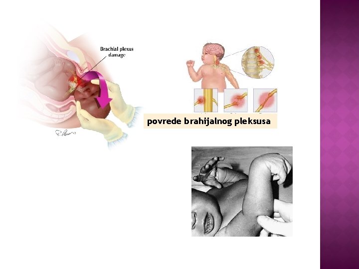 povrede brahijalnog pleksusa 