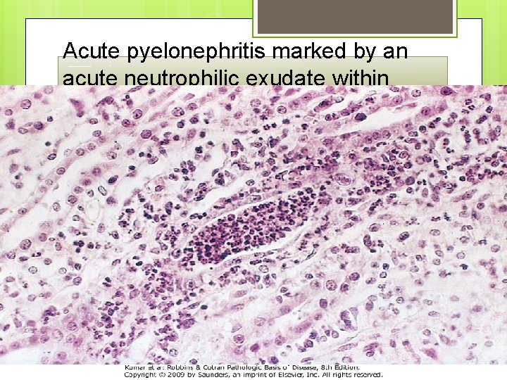 Acute pyelonephritis marked by an acute neutrophilic exudate within tubules and interstitial inflammation 