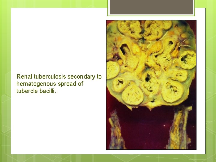 Renal tuberculosis secondary to hematogenous spread of tubercle bacilli. 