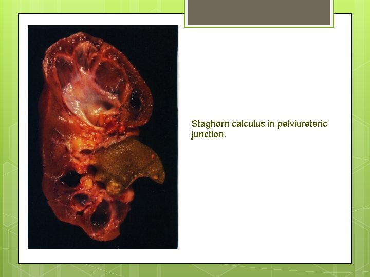 Staghorn calculus in pelviureteric junction. 