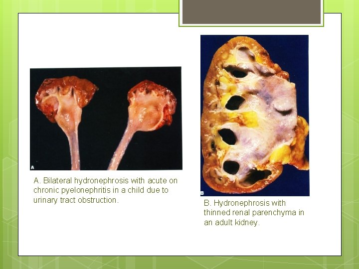 A. Bilateral hydronephrosis with acute on chronic pyelonephritis in a child due to urinary