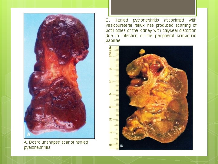 B. Healed pyelonephritis associated with vesicoureteral reflux has produced scarring of both poles of