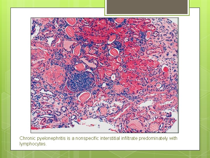 Chronic pyelonephritis is a nonspecific interstitial infiltrate predominately with lymphocytes. 