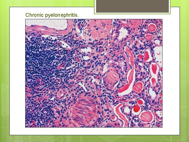 Chronic pyelonephritis. 