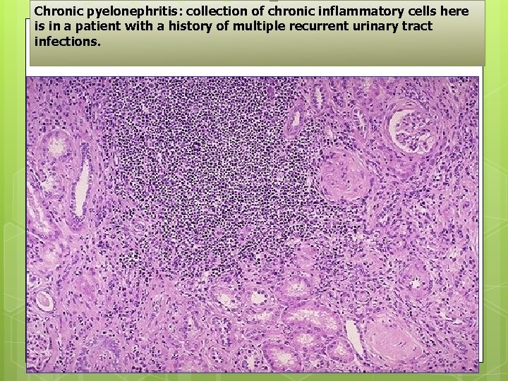 Chronic pyelonephritis: collection of chronic inflammatory cells here is in a patient with a