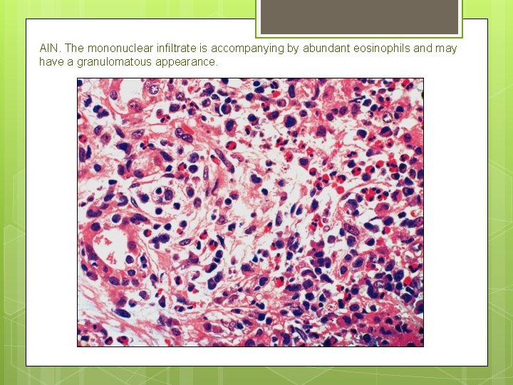 AIN. The mononuclear infiltrate is accompanying by abundant eosinophils and may have a granulomatous