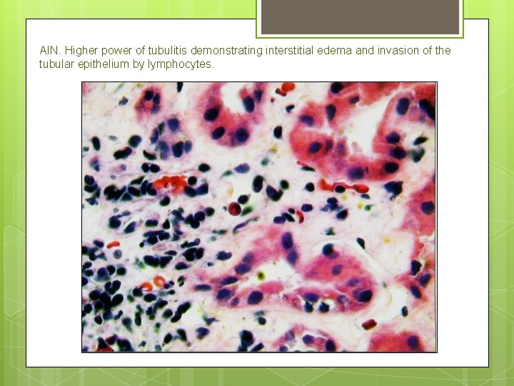 AIN. Higher power of tubulitis demonstrating interstitial edema and invasion of the tubular epithelium