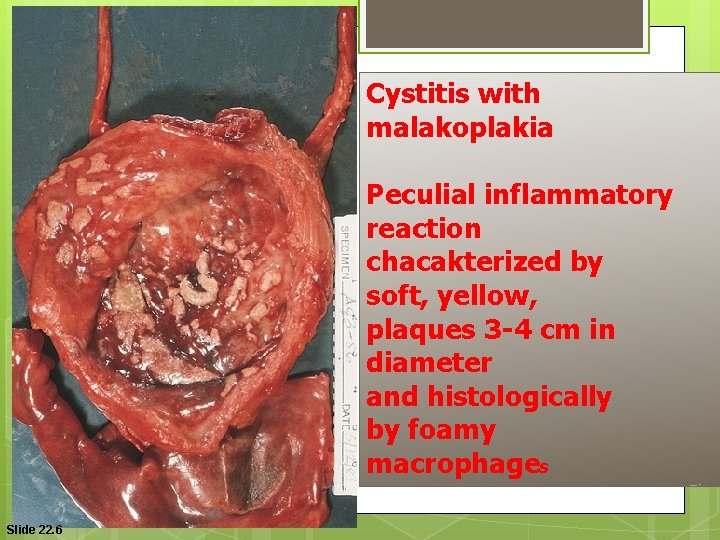 Cystitis with malakoplakia Peculial inflammatory reaction chacakterized by soft, yellow, plaques 3 -4 cm