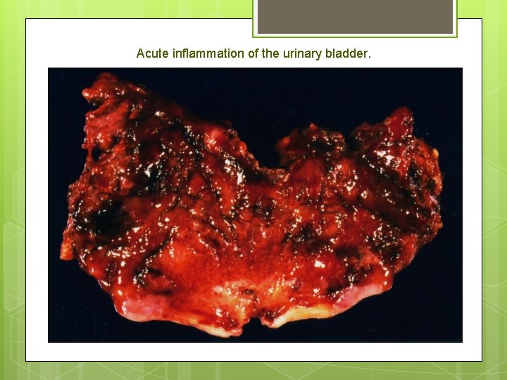 Acute inflammation of the urinary bladder. 