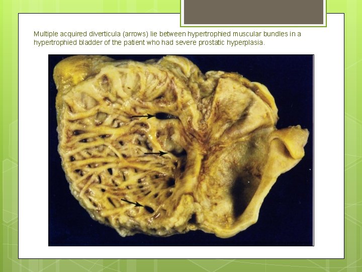 Multiple acquired diverticula (arrows) lie between hypertrophied muscular bundles in a hypertrophied bladder of