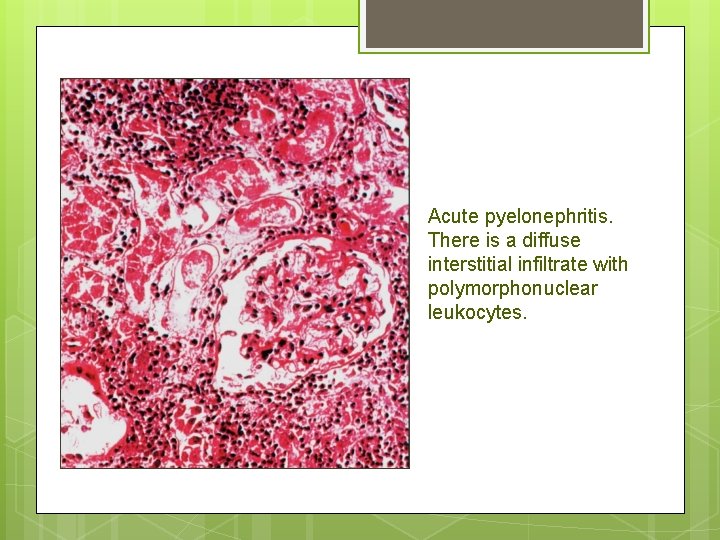 Acute pyelonephritis. There is a diffuse interstitial infiltrate with polymorphonuclear leukocytes. 