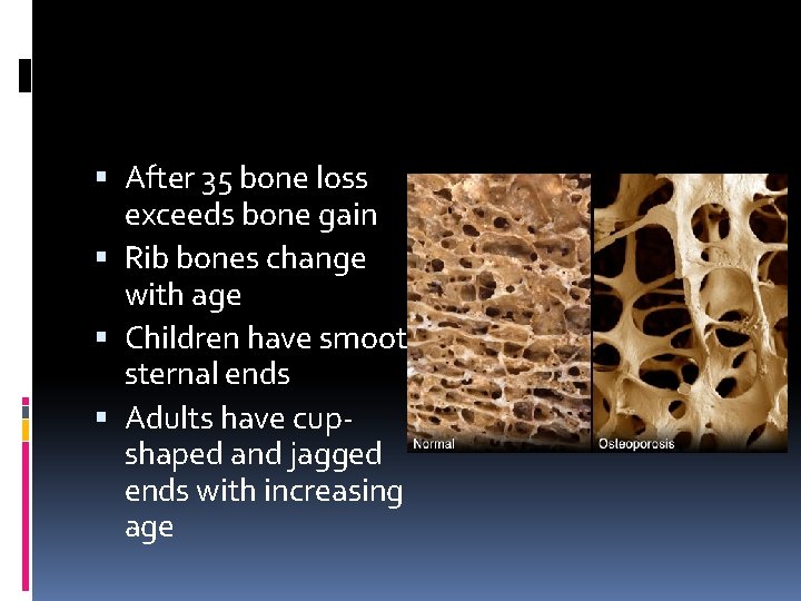  After 35 bone loss exceeds bone gain Rib bones change with age Children