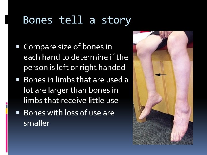 Bones tell a story Compare size of bones in each hand to determine if