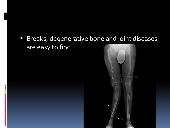  Breaks, degenerative bone and joint diseases are easy to find 